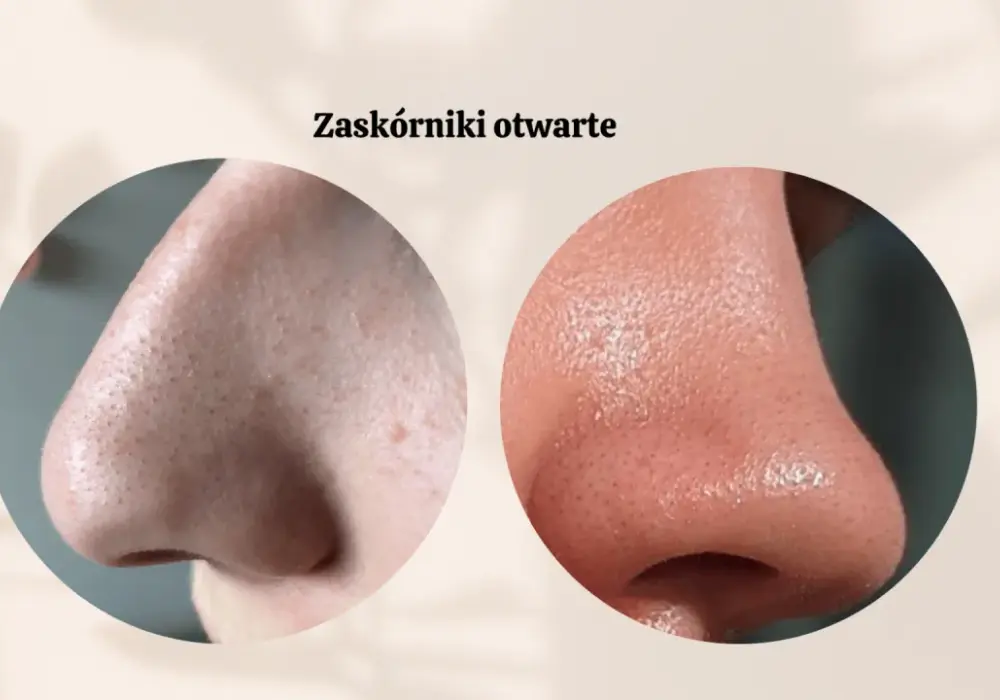 Zaskórniki na nosie: Skuteczne sposoby i jak ich unikać