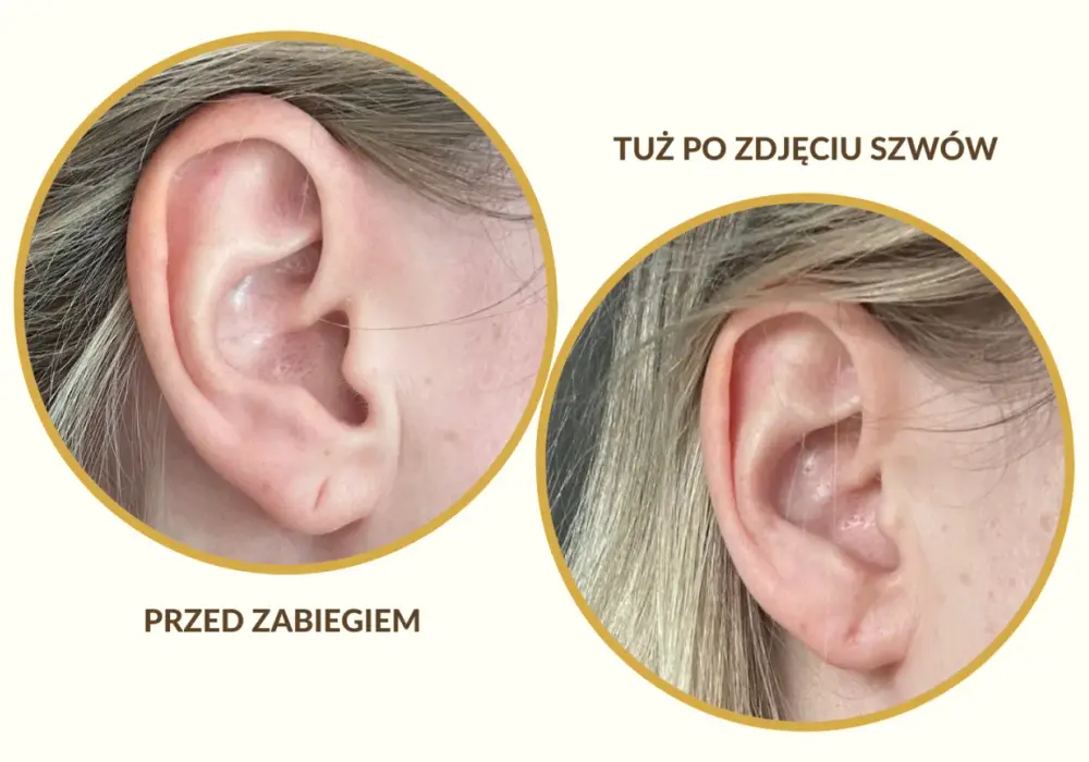 Druga dziurka w uchu: Przewodnik po zabiegu, gojeniu i stylizacji