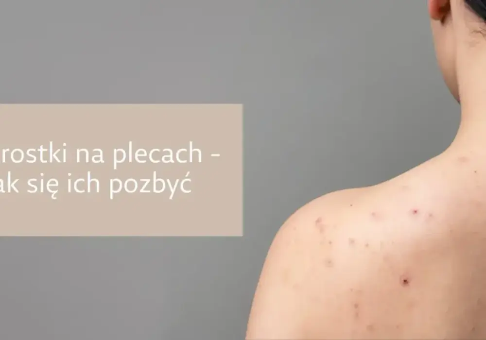 Krosty na plecach: Skuteczne sposoby na pozbycie się i zapobieganie
