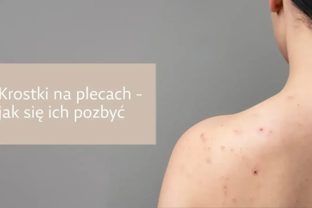 Krosty na plecach: Skuteczne sposoby na pozbycie się i zapobieganie