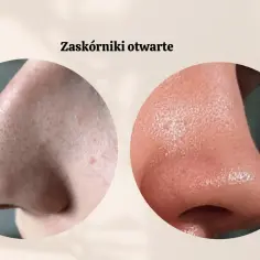 Zbliżenie na nos z widocznymi zaskórnikami otwartymi. Dwa okręgi ukazują różne tekstury skóry i pory.