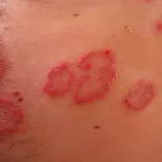 Czerwone, łuszczące się plamy na brzuchu, objawy atopowego zapalenia skóry.