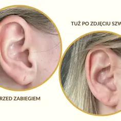 Ucho przed i po zabiegu. Widoczna druga dziurka w uchu, która została poprawiona.