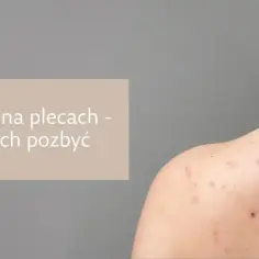 Widok z tyłu na plecy z widocznymi krostami. Tekst informuje o tym, jak pozbyć się krost na plecach.