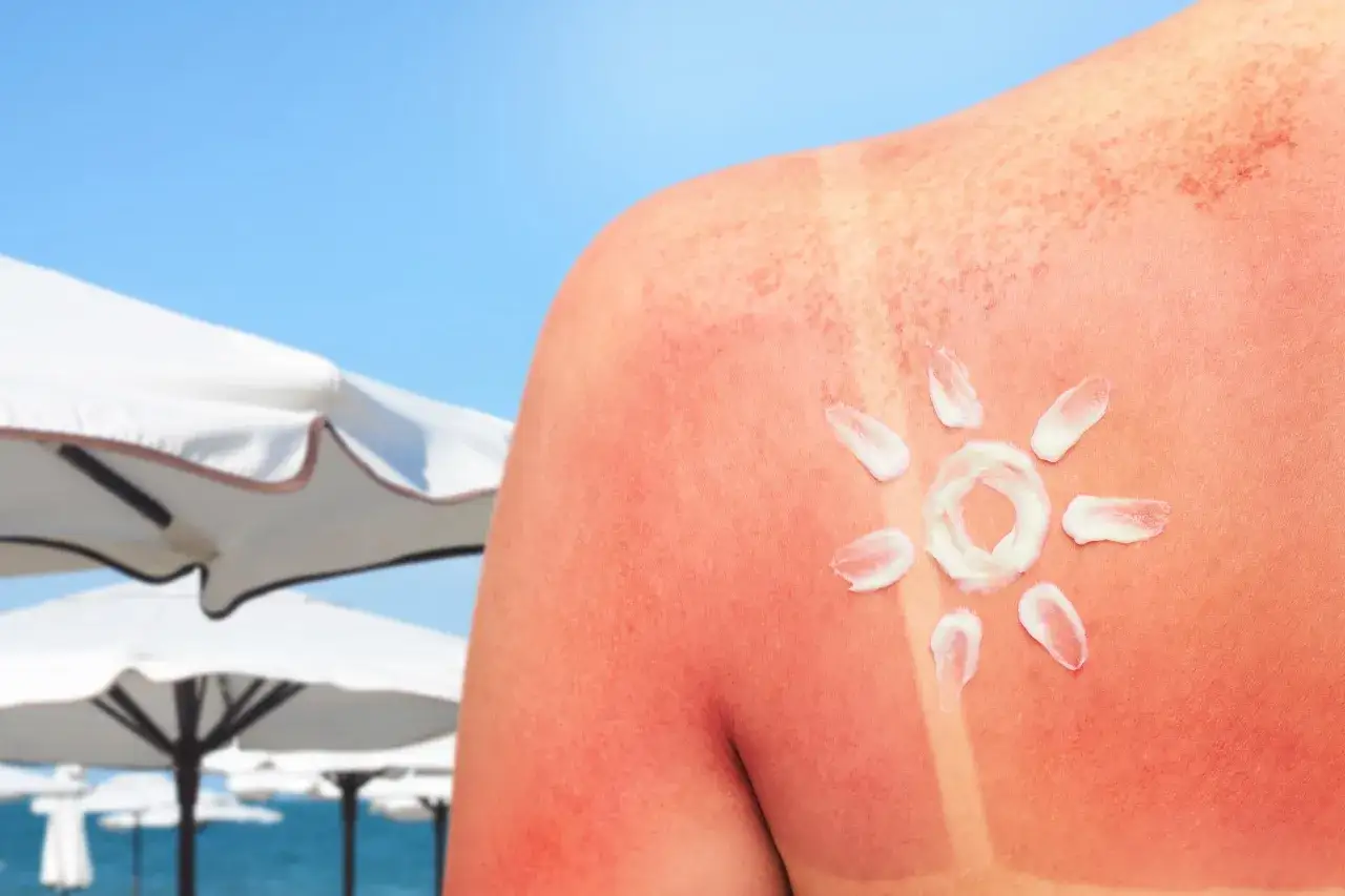 Krem na oparzenia słoneczne w kształcie słońca na zaczerwienionej skórze. Na plaży, w tle białe parasole i błękitne niebo.