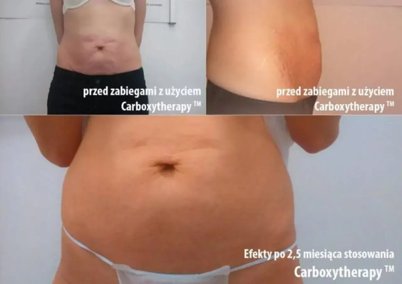 Przed i po karboksyterapii na cellulit: widoczna poprawa skóry brzucha po 2,5 miesiąca stosowania zabiegów.