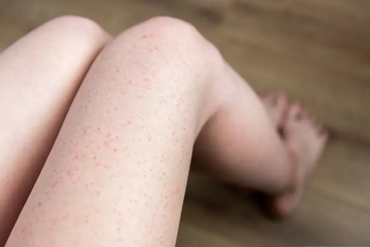 Skóra nóg z licznymi czerwonymi krostkami po goleniu. Dowiedz się, jak pozbyć się krostek po goleniu i cieszyć się gładką skórą.