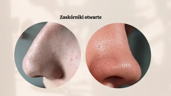 Zaskórniki na nosie: Skuteczne sposoby i jak ich unikać