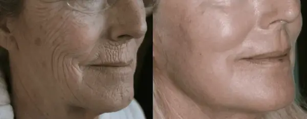 Najmocniejsze peelingi chemiczne: TCA vs Fenol - efekty i ryzyko