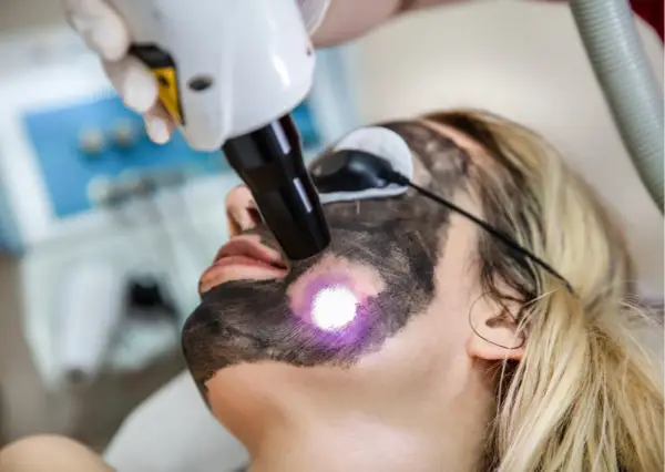 Laserowy Peeling Węglowy: Efekty "Przed i Po" | Kompleksowy Przewodnik