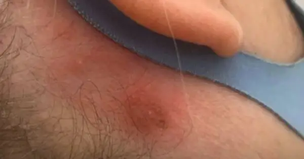 Alergia na farbę do włosów? Jak rozpoznać i skutecznie sobie radzić