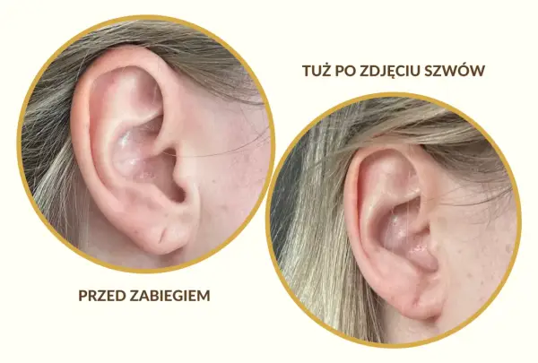 Druga dziurka w uchu: Przewodnik po zabiegu, gojeniu i stylizacji